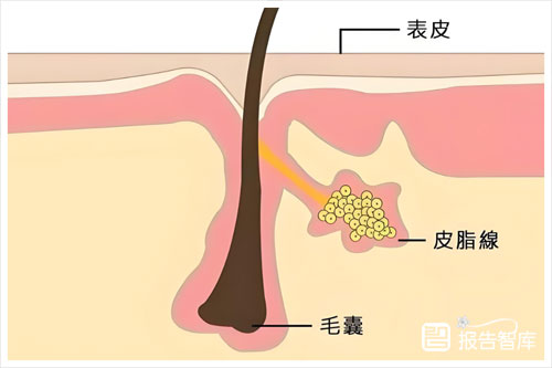 科瑞肤：2024国人毛孔粗大研究进展如何？毛孔粗大的原因分析（49页）